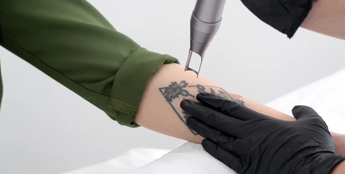 Previously incarcerated individual undergoing tattoo removal